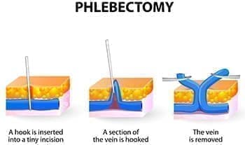 Минифлебэктомия